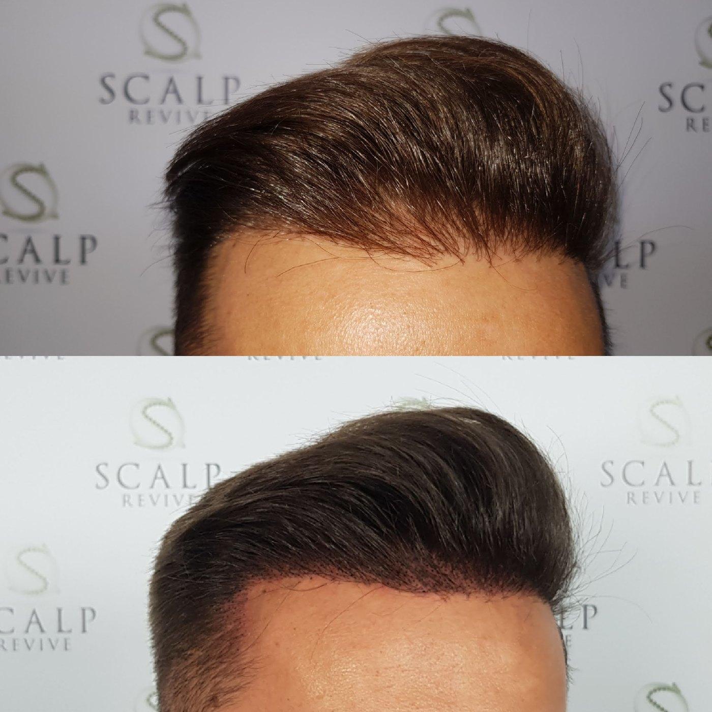 Before and after views of a man's front hairline, with the lower image showing a soft
