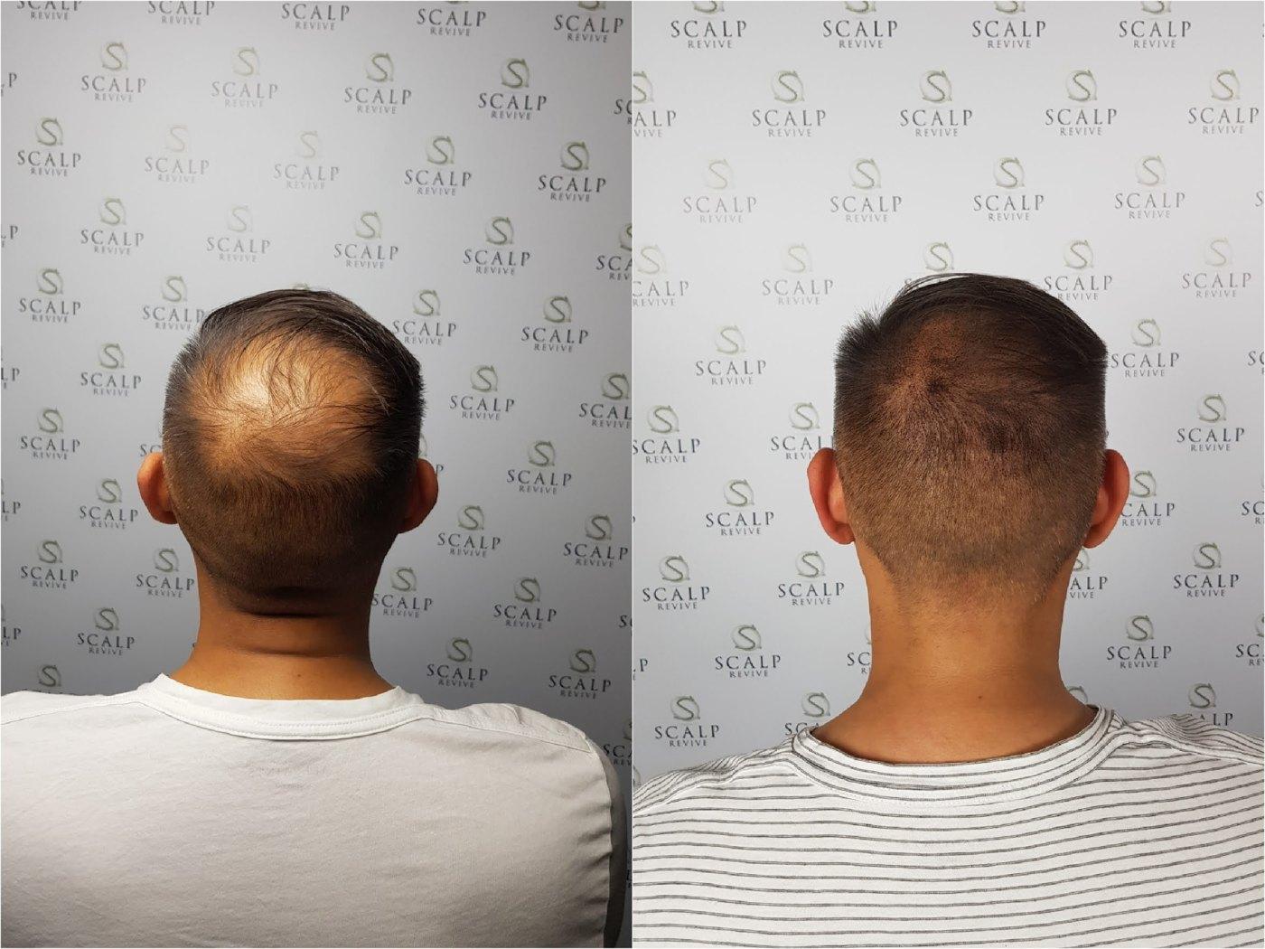 Before and after rear views of a man's crown: thinning hair on the left, a denser, evenly shaded buzzed crown on the right.