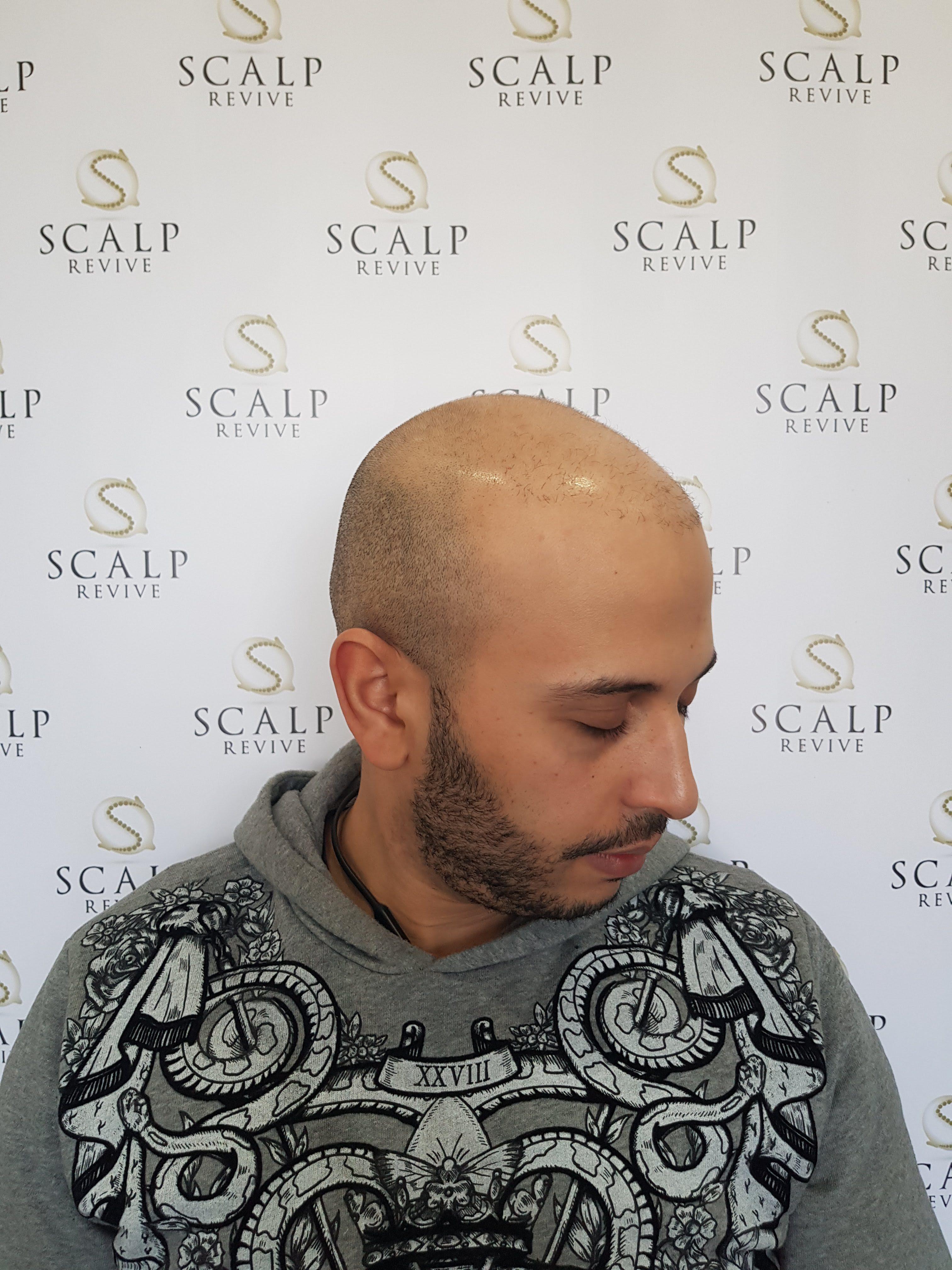 Client's first scalp micropigmentation session, hairline still filling in