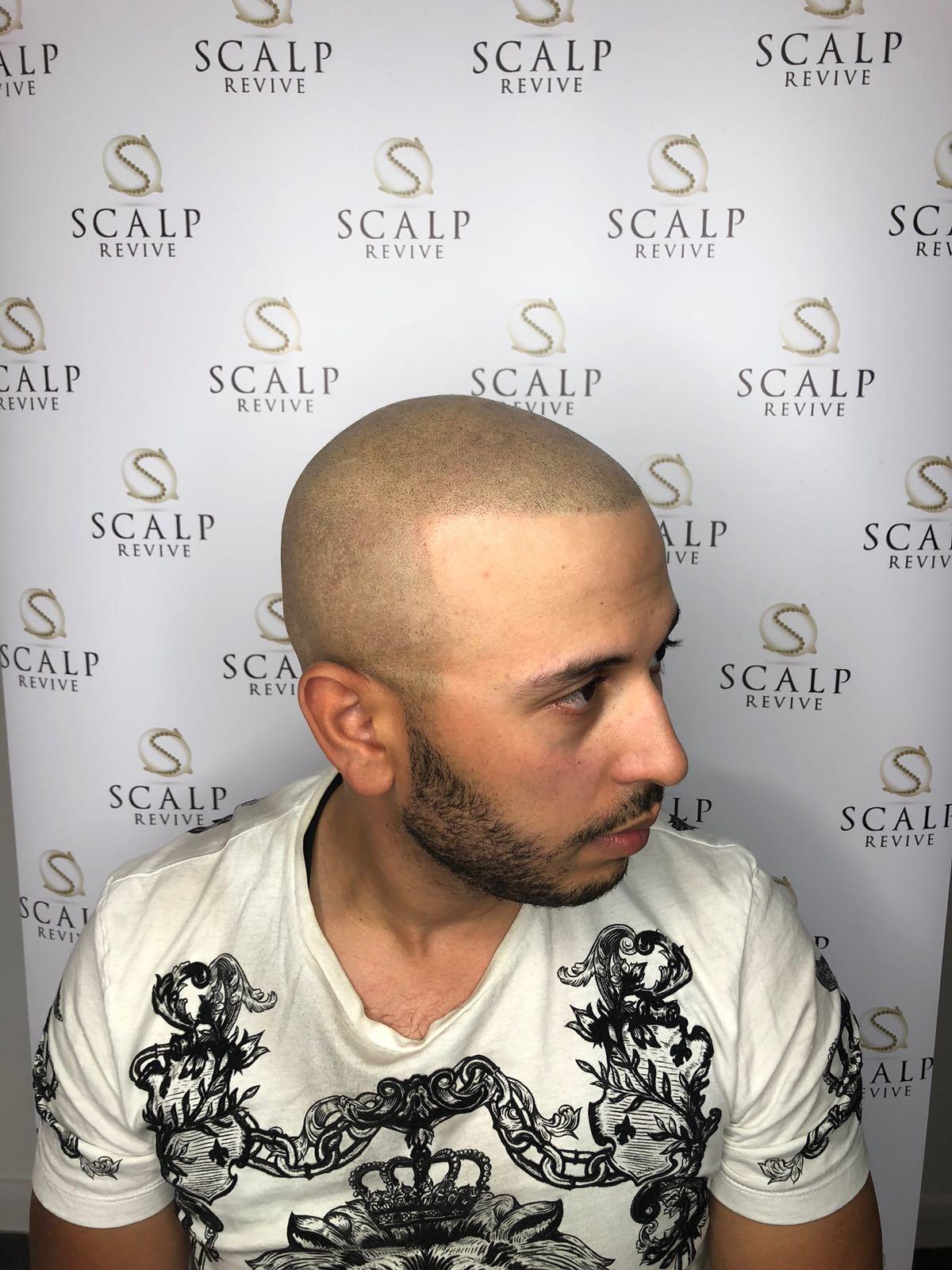 Same client after a later session, with a fully dense hairline