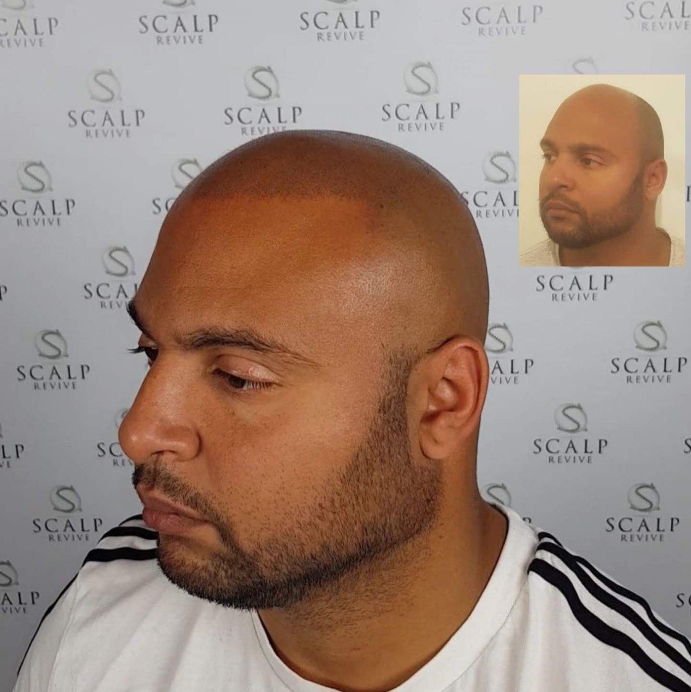 Side profile of a bearded man with a closely shaved scalp and defined hairline