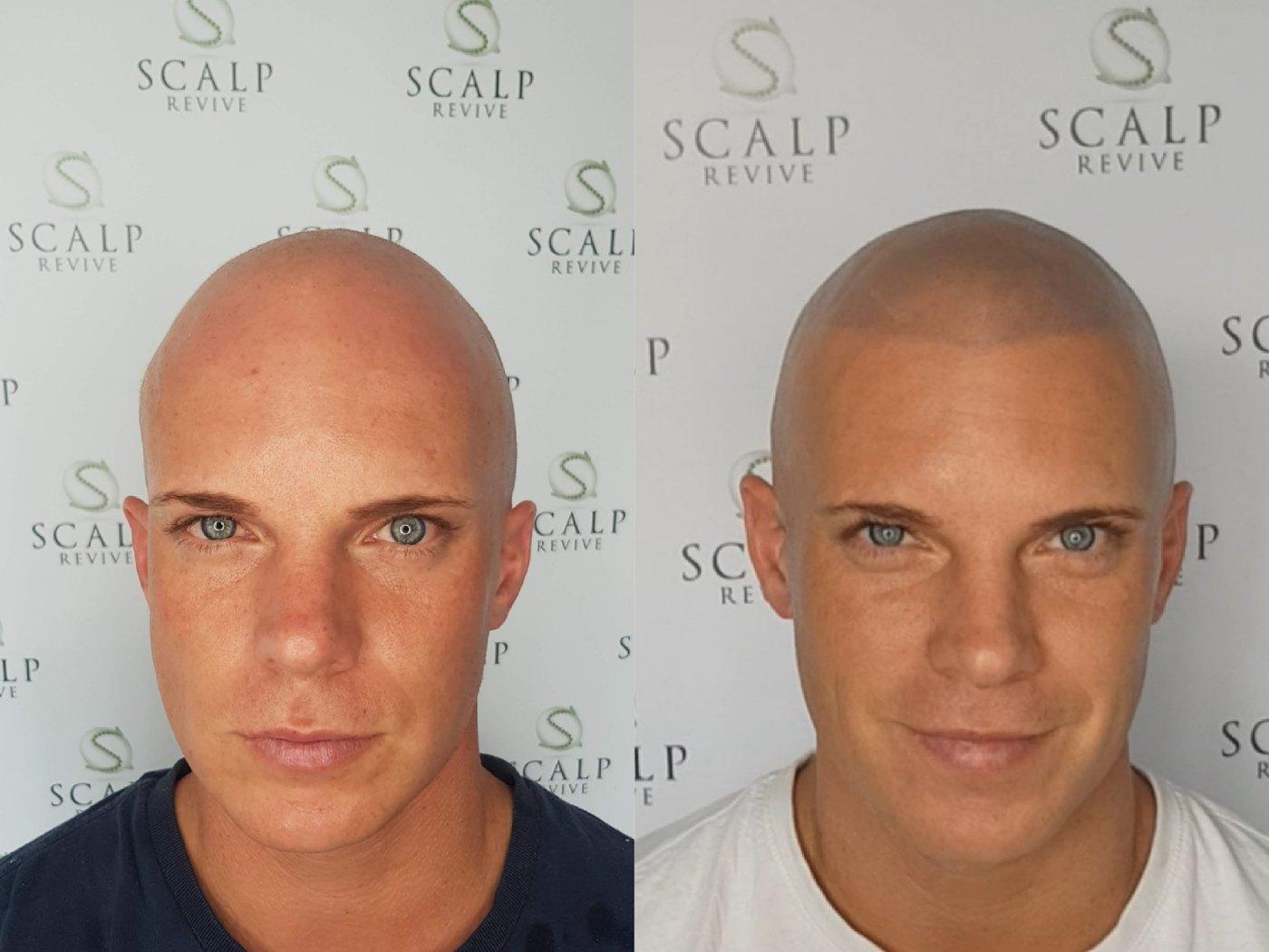 Before and after front views of a bald man; the after photo shows a shaded, even scalp pigment look with a defined hairline.