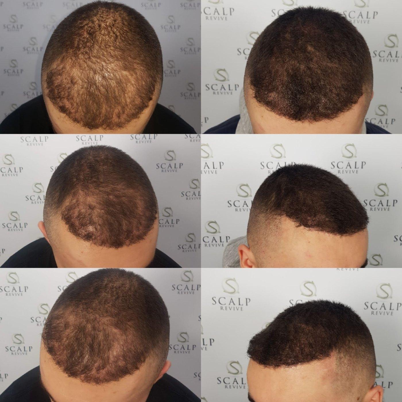 Collage of six views of a man's closely cropped scalp from the top and side, with a dense