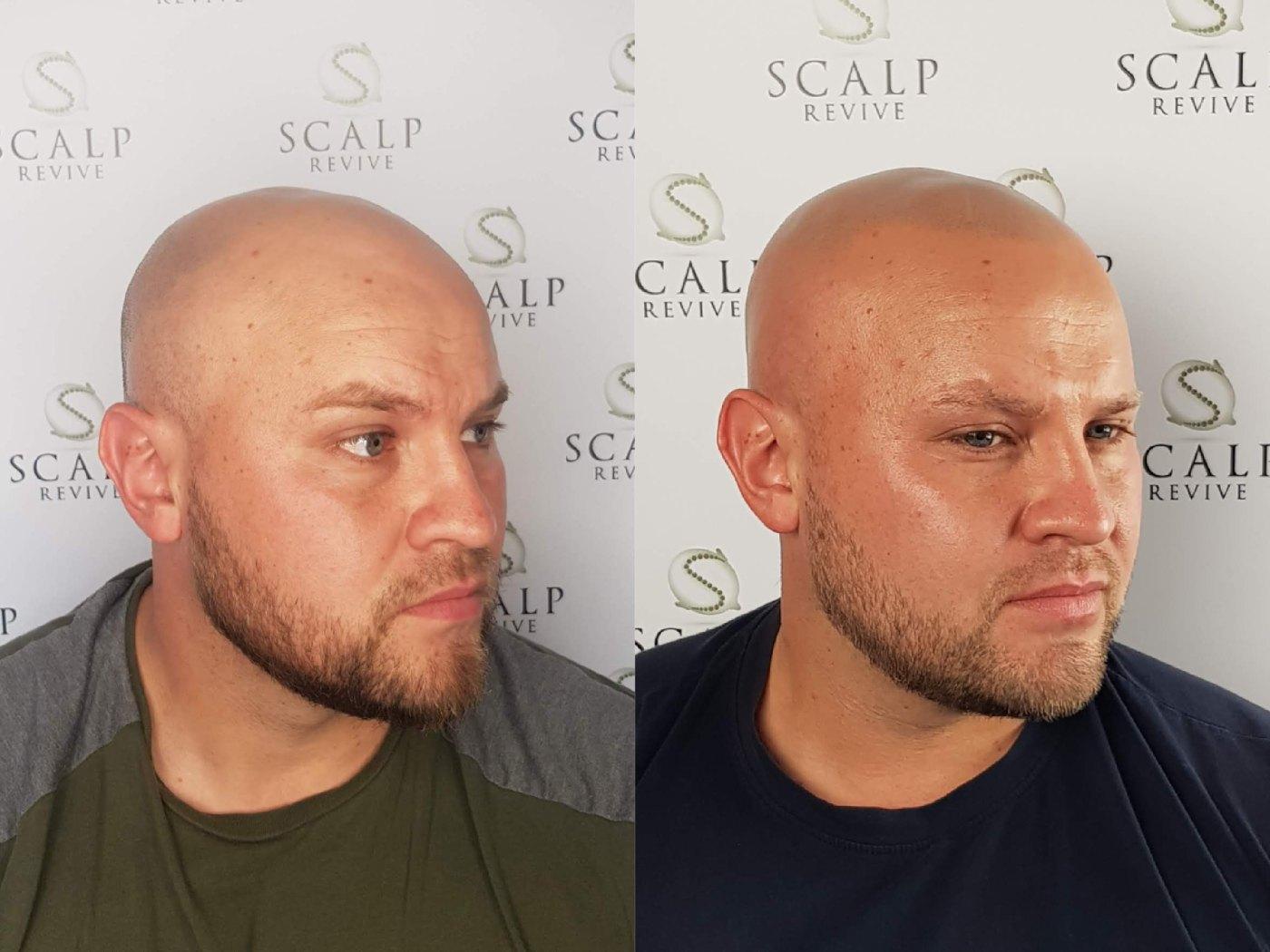 Before and after side views of a bald bearded man, with a closely shaved, evenly toned scalp in the after photo