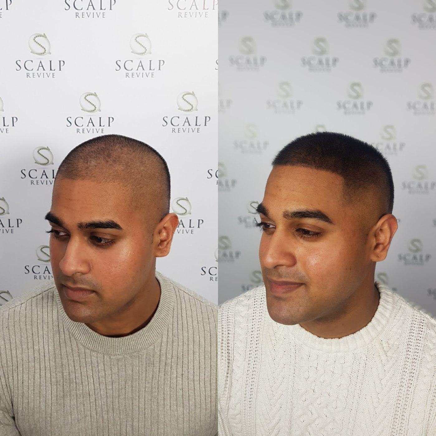 Before and after of a man with a closely shaved head, showing a fuller, denser hairline and scalp in the after photo.