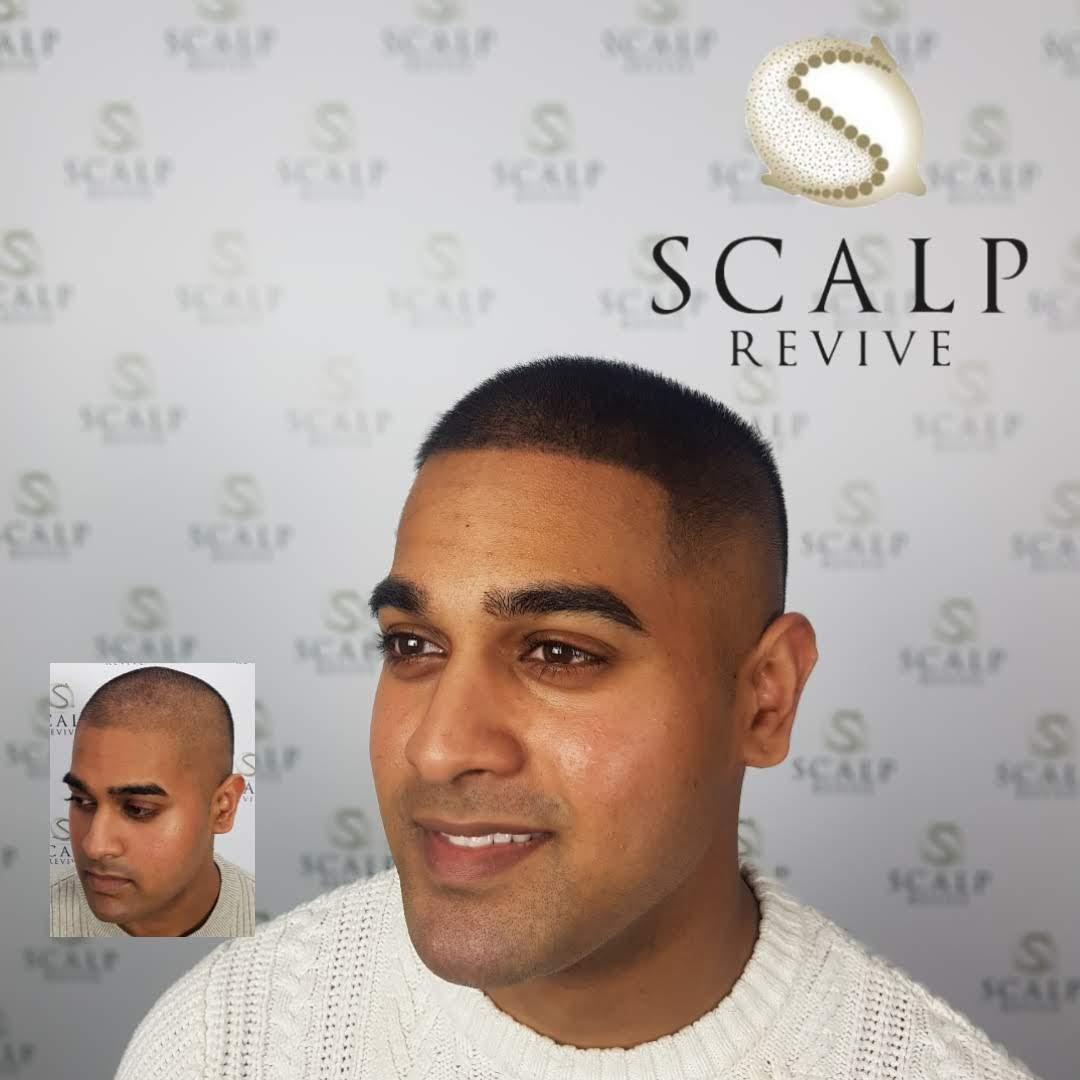 scalp micropigmentation uk