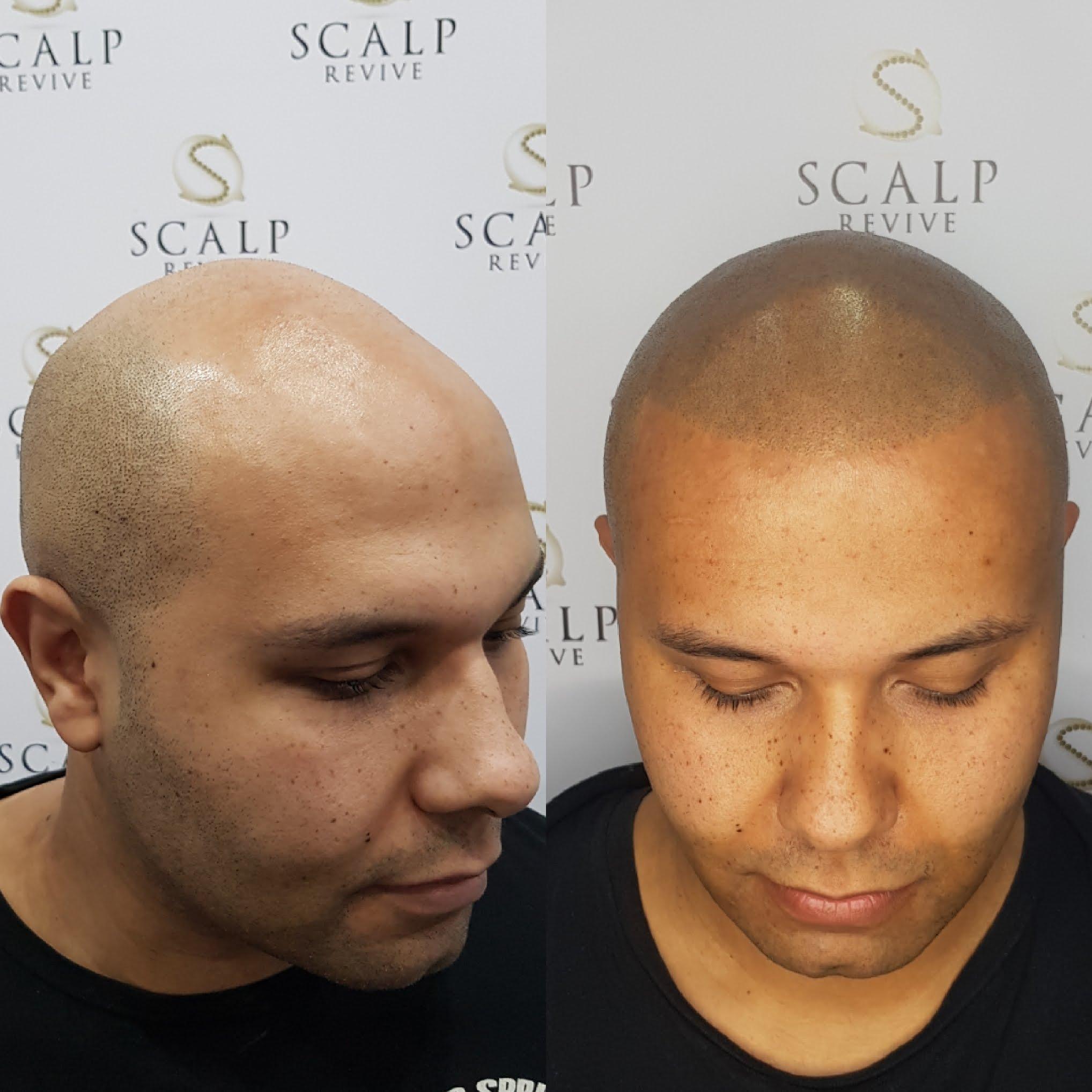 scalp micropigmenation leeds