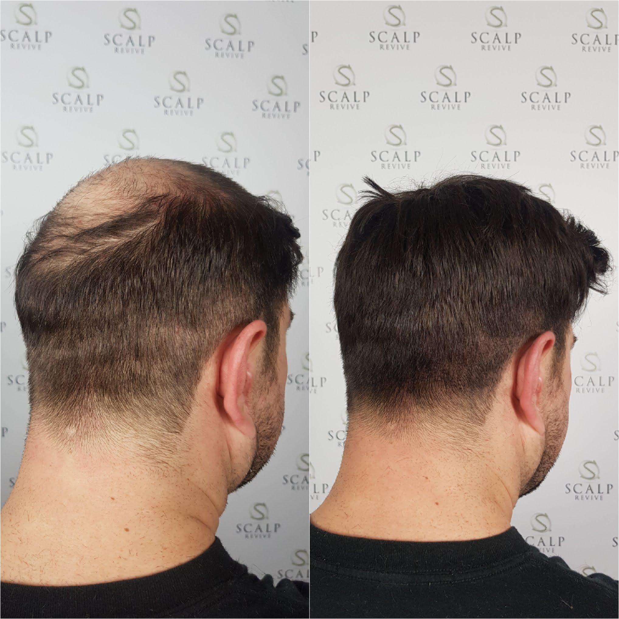 leeds scalp