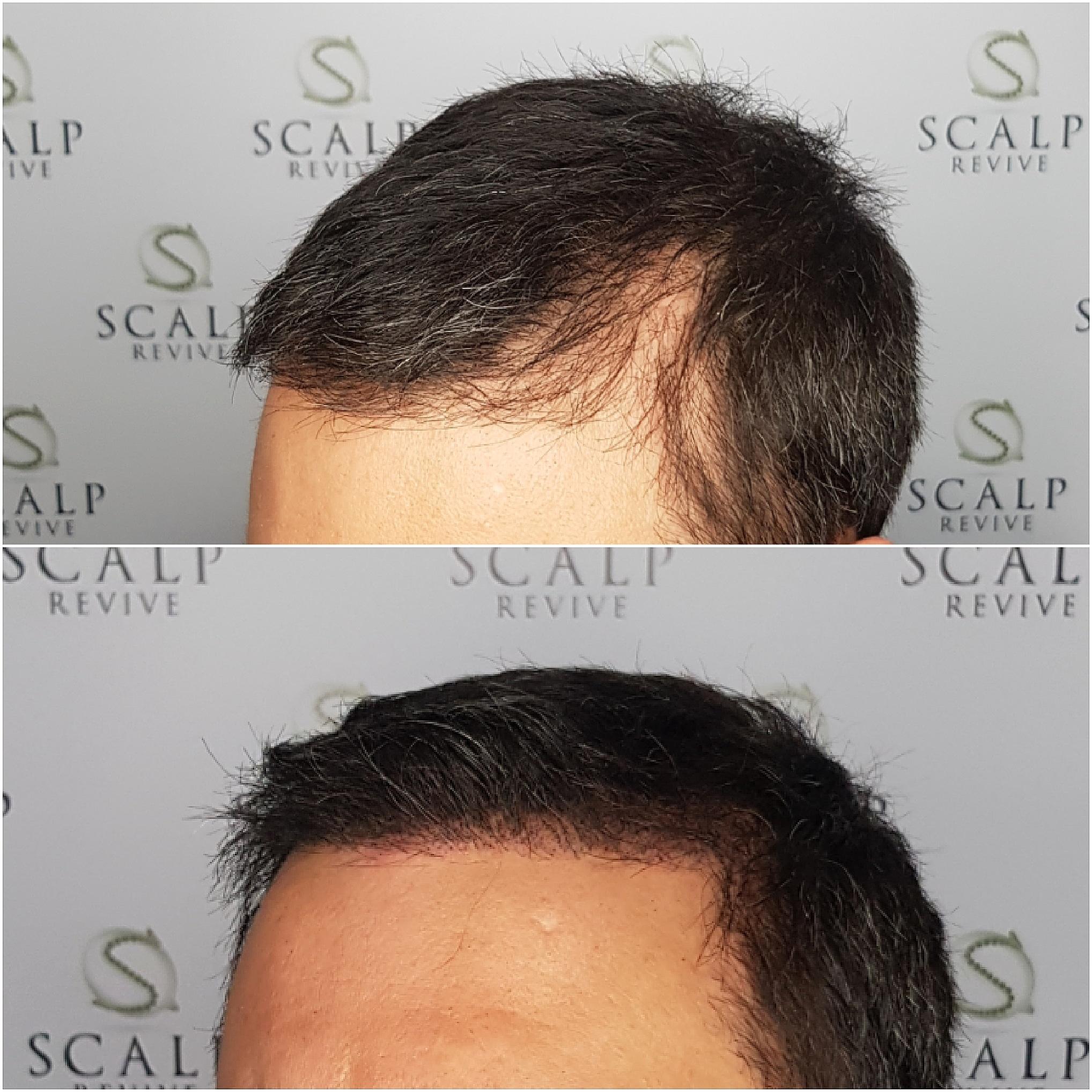 hair transplant smp leeds