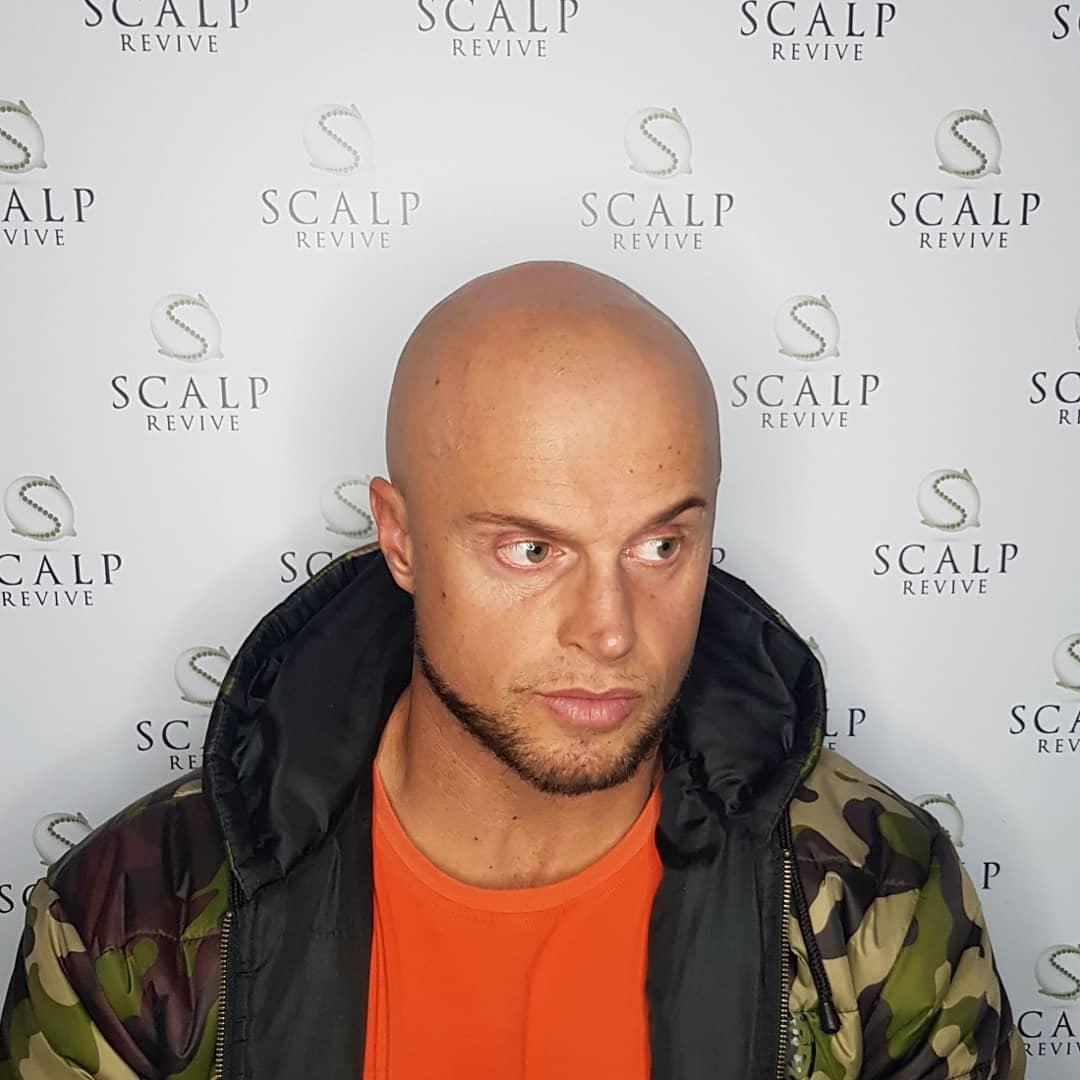 scalp micropigmentation Leeds. hair tattoo Uk. scalp micropigmentation cost.