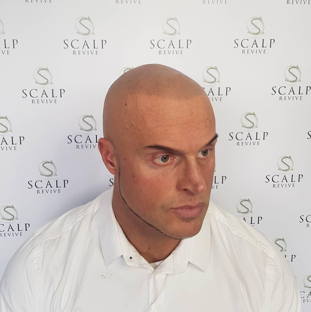 Scalp Revive Leeds. thinning hair treatments leeds