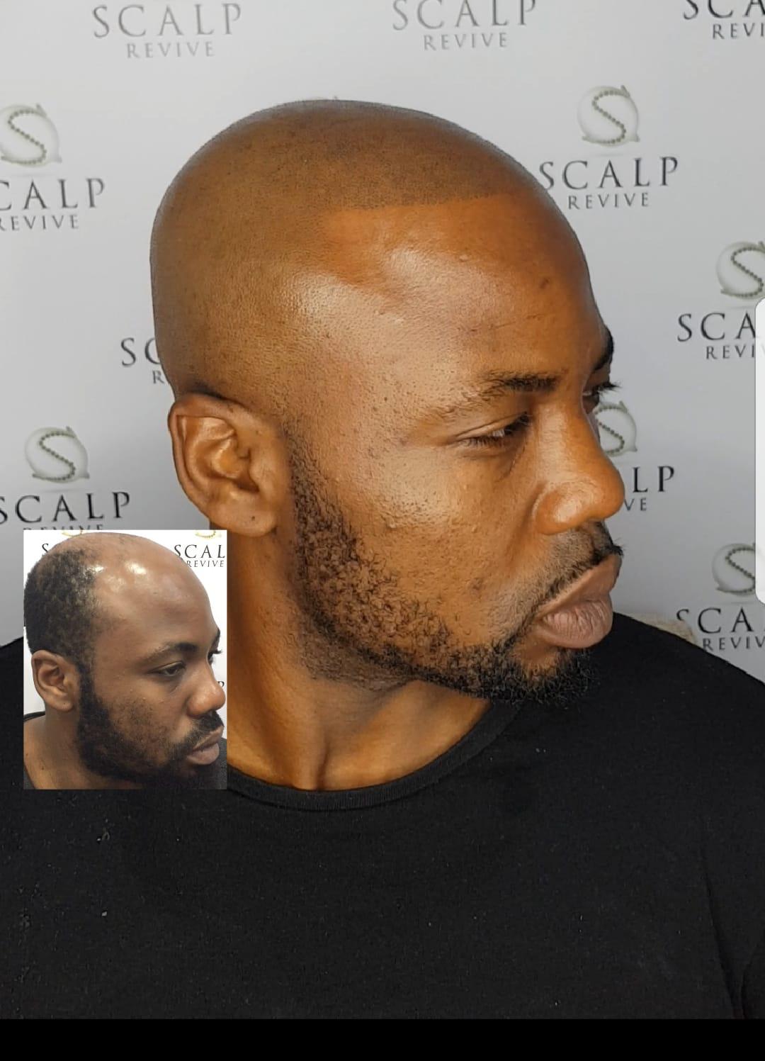smp leeds hair tattoo. hair loss treatments leeds. skin fade