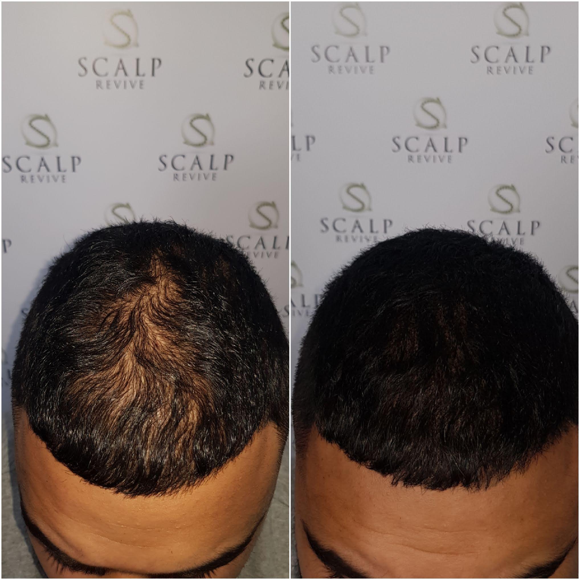 Long Hair SMP, Scalp micropigmentation UK. Hair tattoo Leeds. thinning hair Leeds