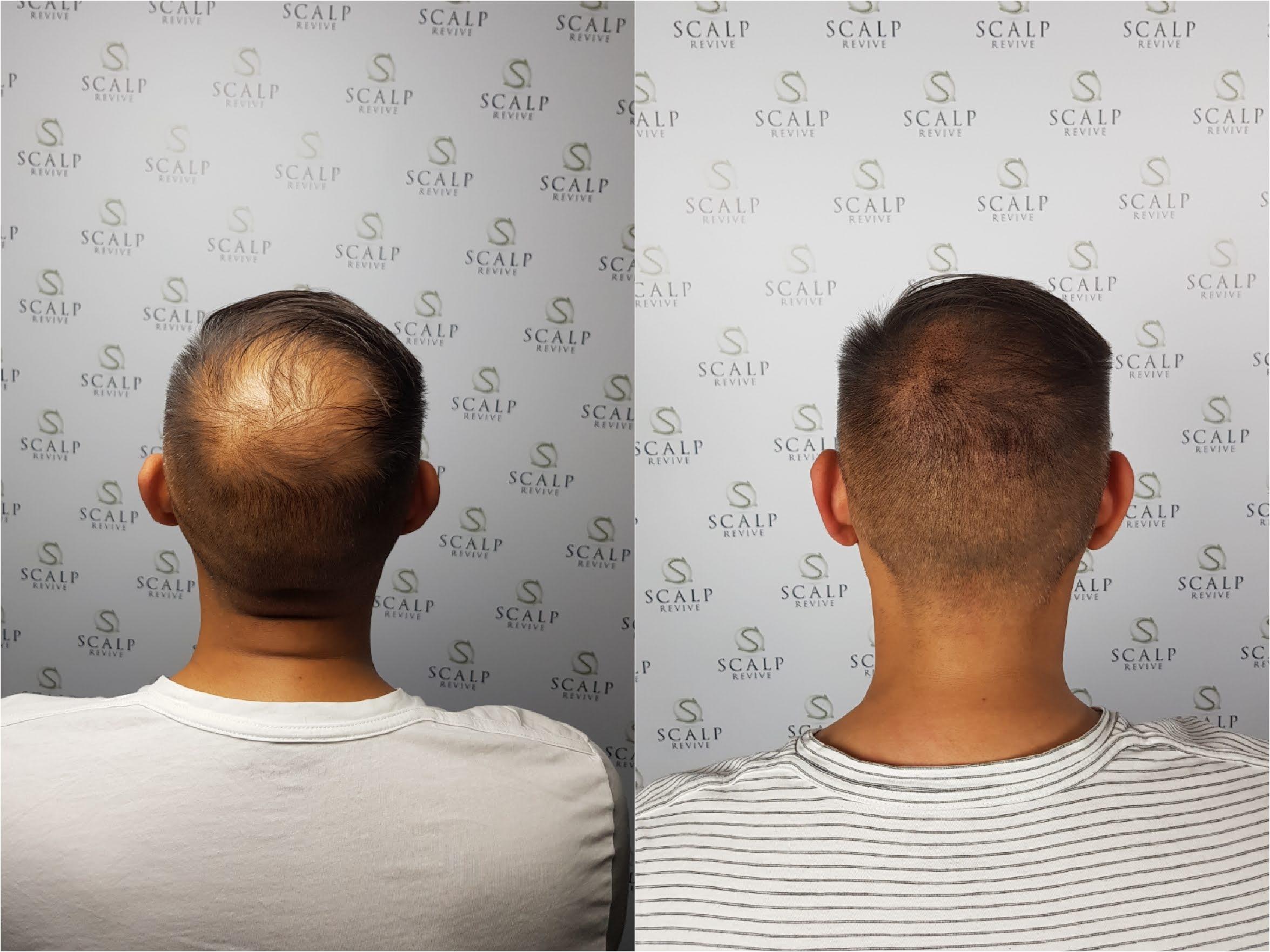 hair tattoo in Leeds. SMP Uk. Scalp Micro Pigmentation UK