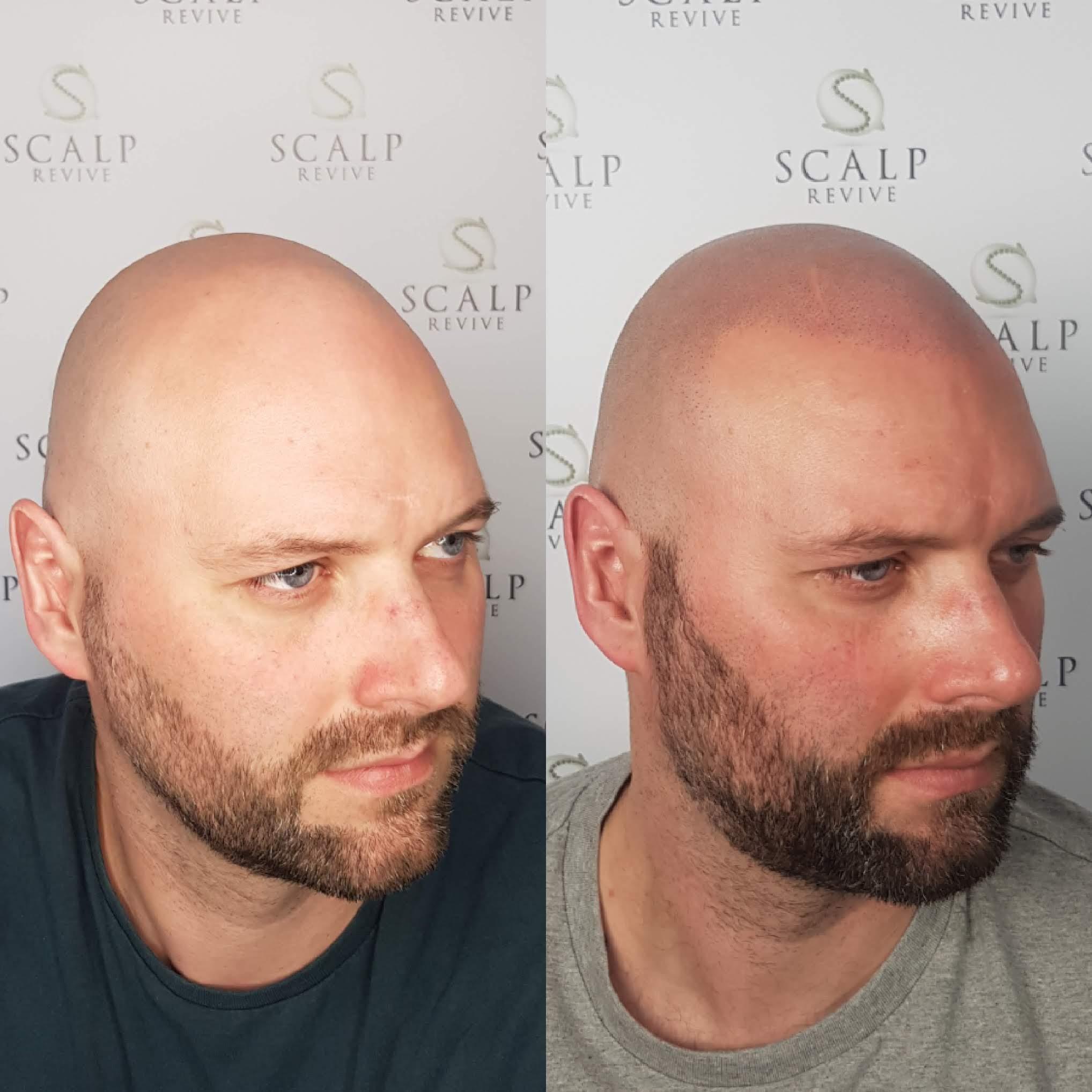 scalp leeds