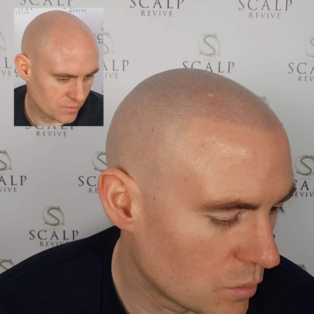 scalp micropigmentation uk
