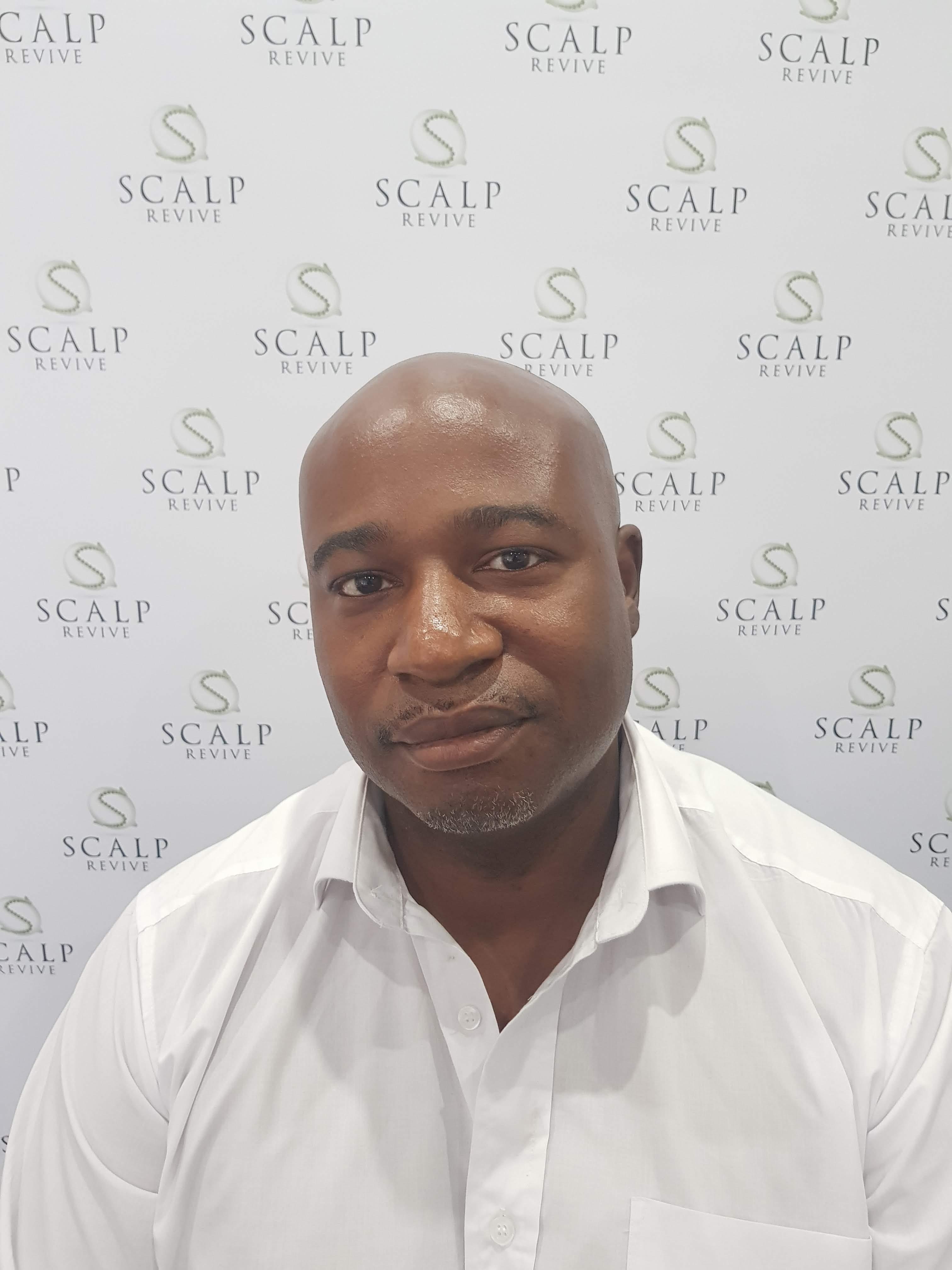 scalp micropigmentation in Leeds