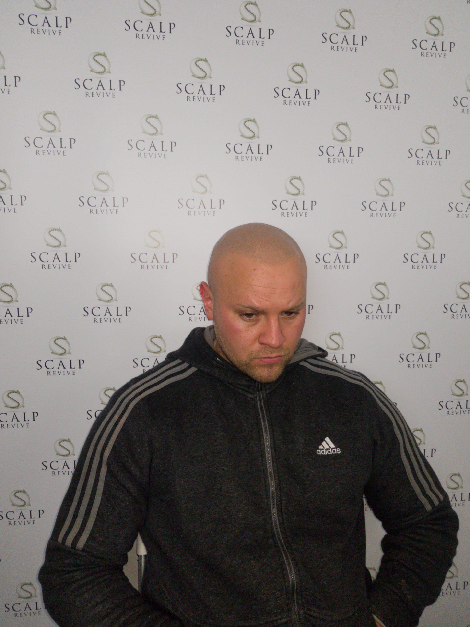 scalp leeds