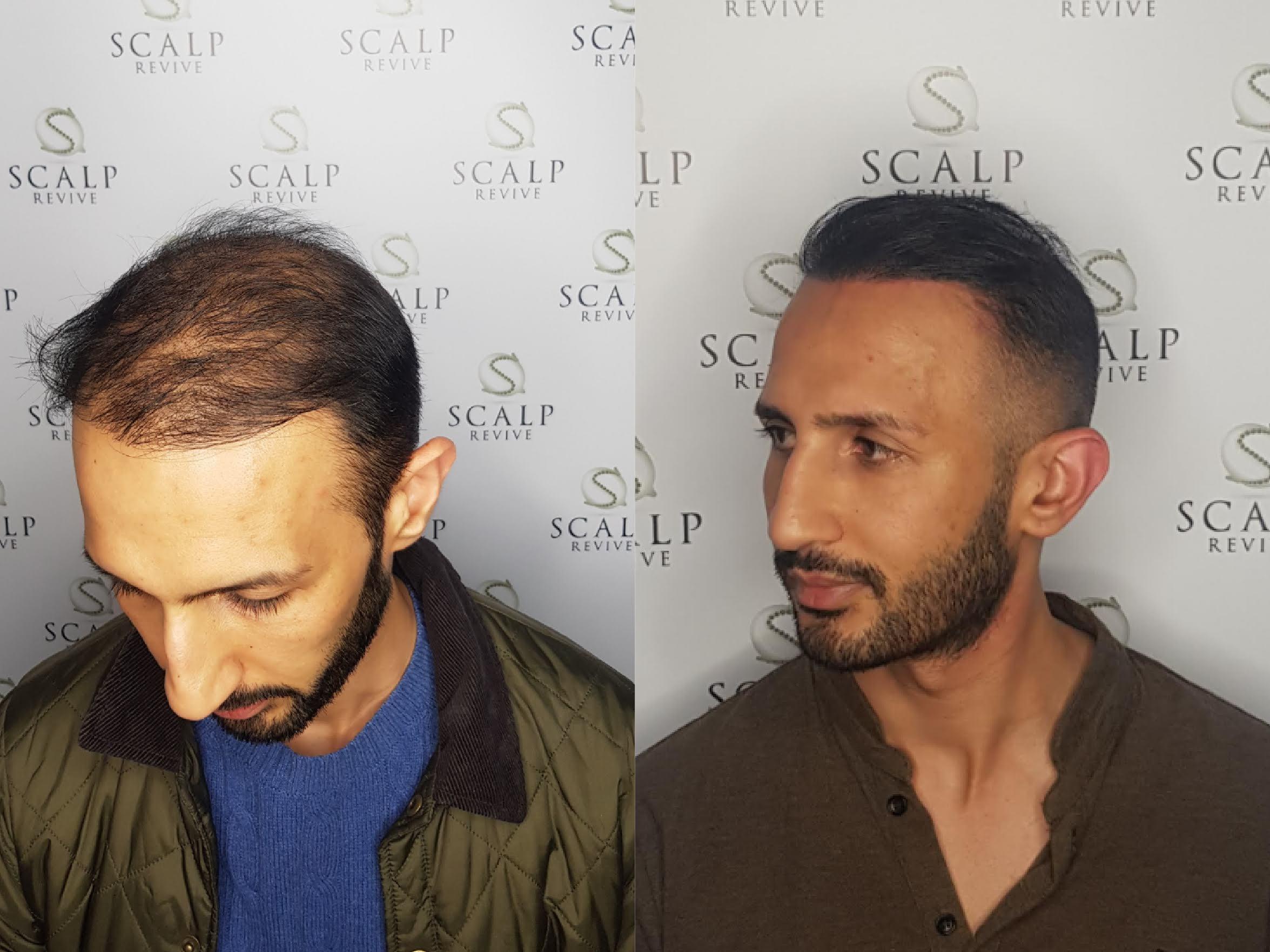 Leeds Scalp Micropigmentation, Hair transplant smp. Leeds.