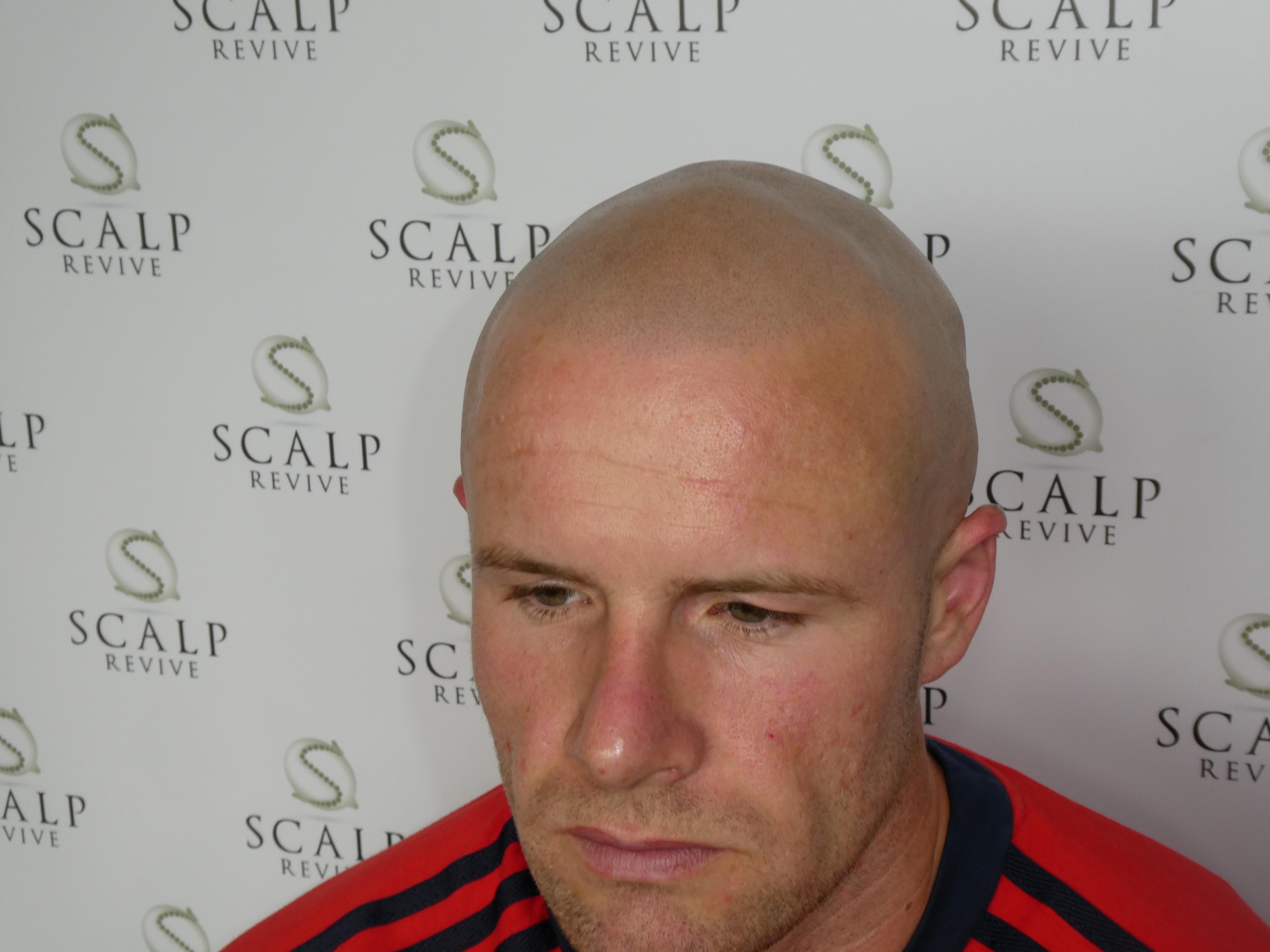 Scalp Micropigmentation Leeds. scalp micropigmentation UK.