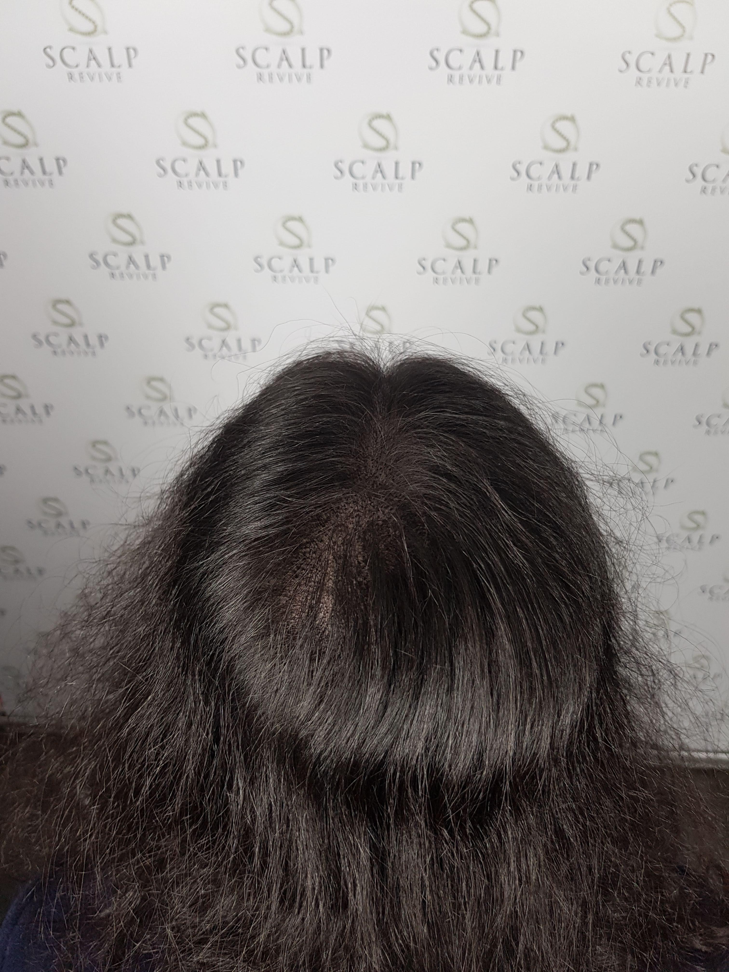 Scalp Micropigmentation for women. hair loss for women. Leeds